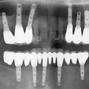implant dentaire villefranche