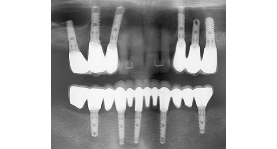 implant dentaire villefranche