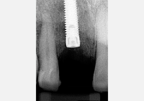 implant dentaire étape 1