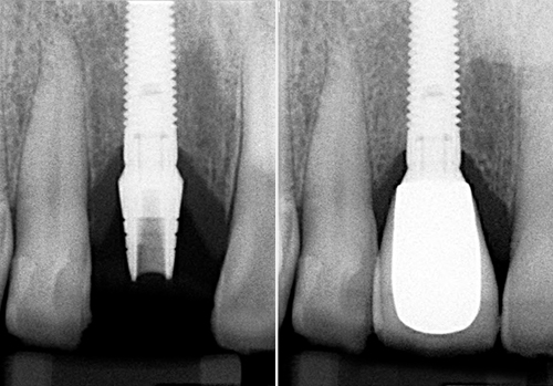 implant dentaire étape 2