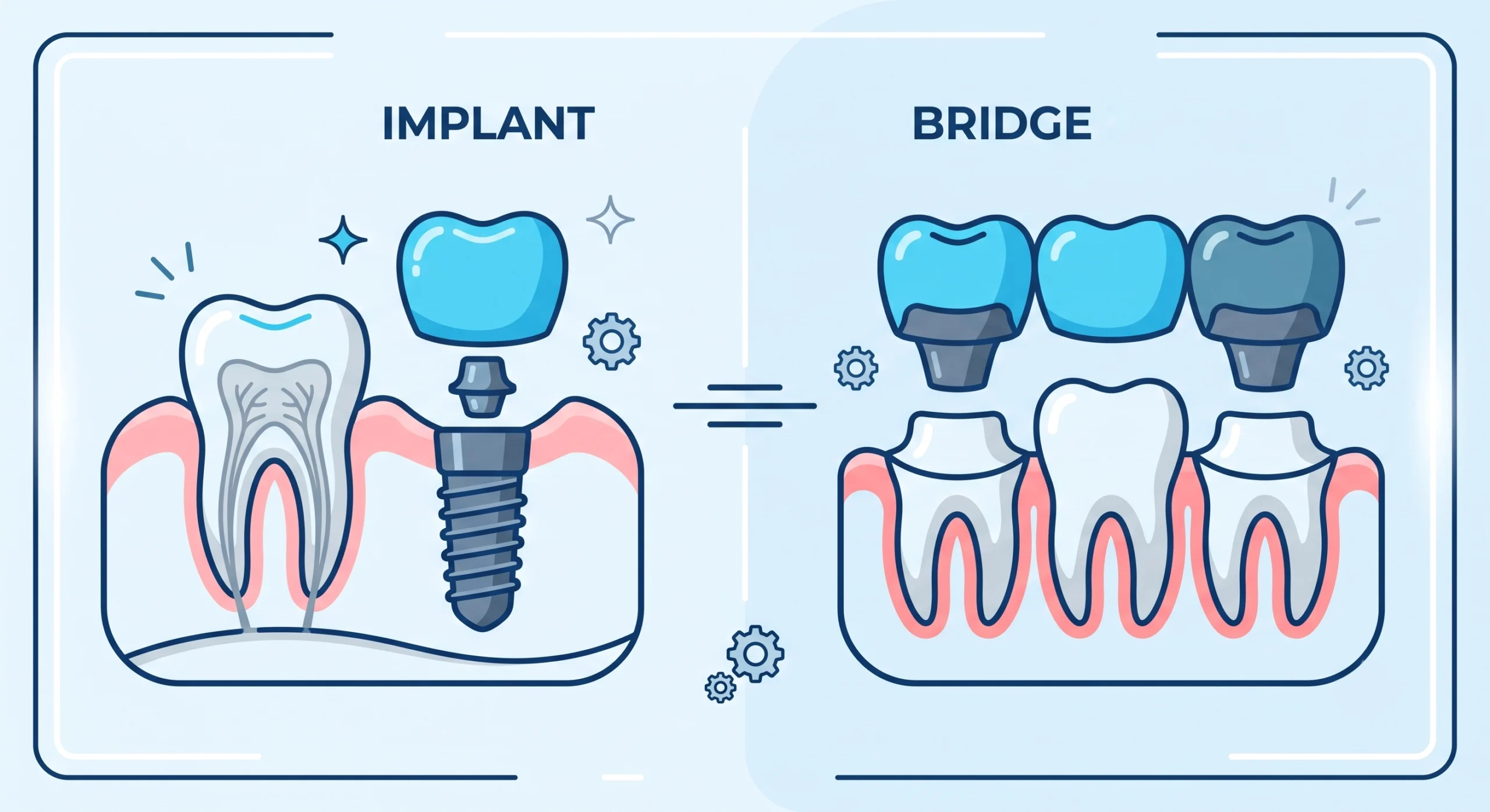 Comment remplacer une dent absente à Villefranche-sur-Saône ? Implant vs Bridge